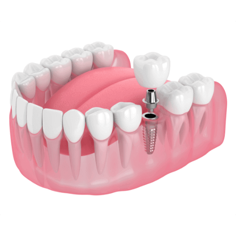 dental implants
