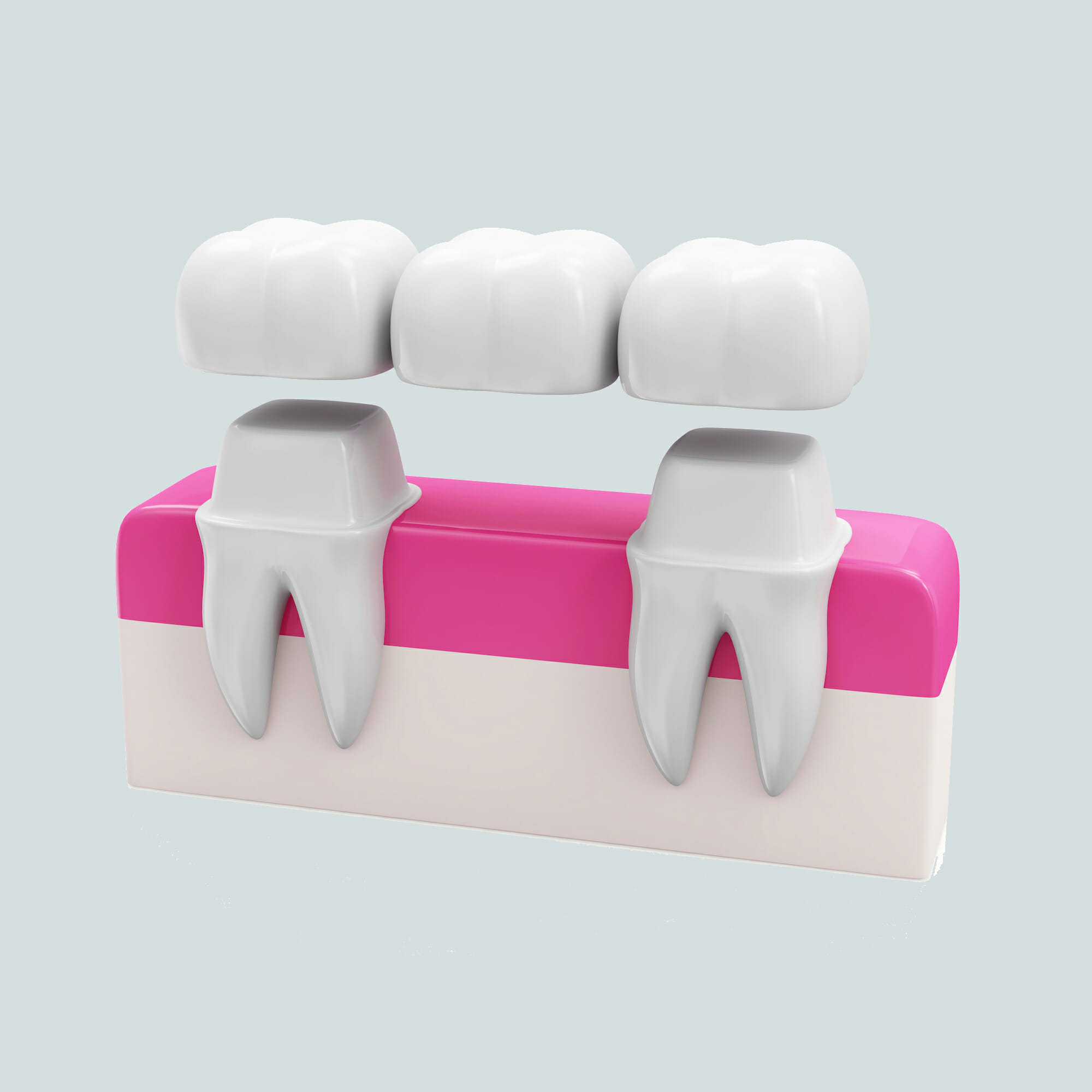 dental-bridge-dental-crown-tooth
