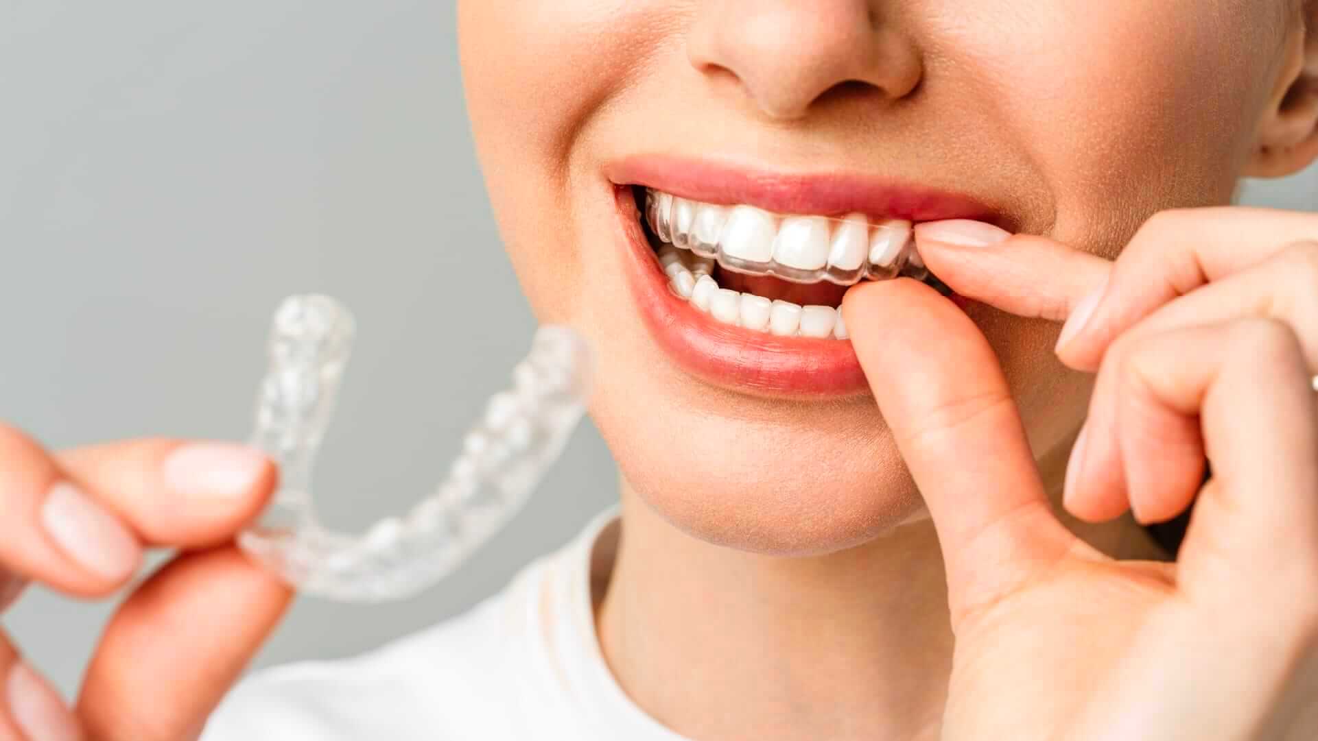 6 Reasons Why Angel Aligner Are Better
