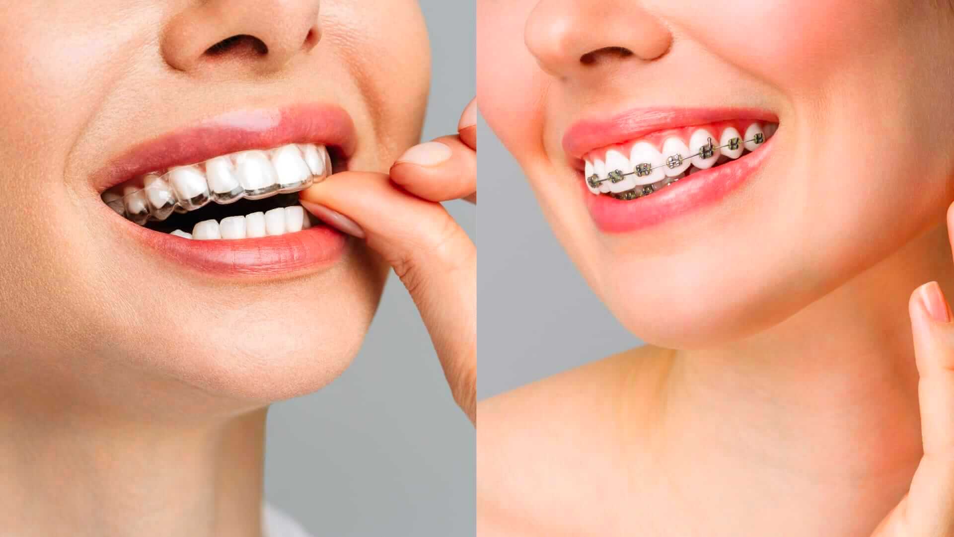 Angel Aligner vs. Pendakap Gigi Tradisional – Yang Mana Lebih Baik?